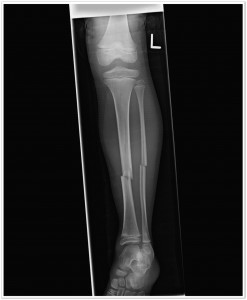 X-Ray of a Broken Leg